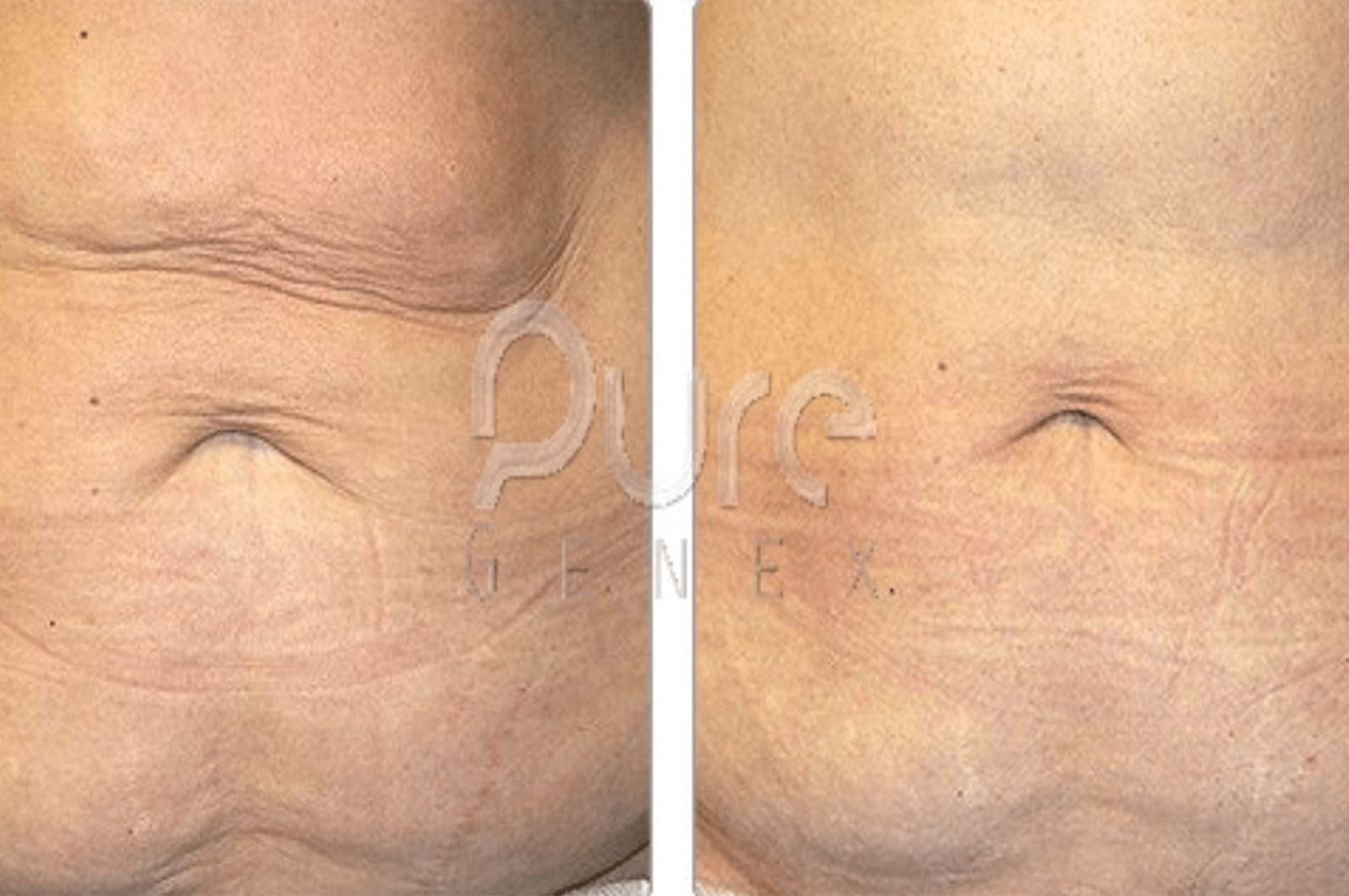 Stretch Mark reduction form Imagineux machines