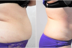 Accelerated Laser Lipo